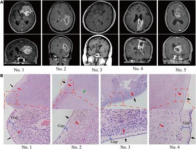 The Ependymal Region Prevents Glioblastoma From Penetrating Into the Ventricle via a Nonmechanical Force